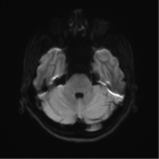 Abducens nerve palsy (Radiopaedia 51069-56648 Axial DWI 34).png