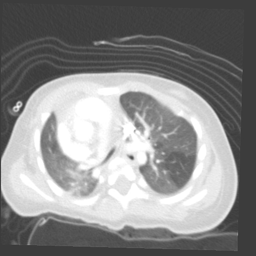 File:Aberrant left pulmonary artery (pulmonary sling) (Radiopaedia 42323-45435 Axial lung window 16).jpg