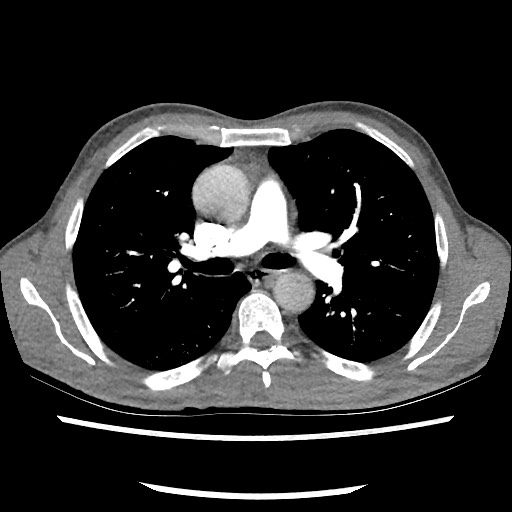 Accessory left horizontal fissure with lingular pneumonia (Radiopaedia 53763-59843 Axial C+ CTPA 42).jpg