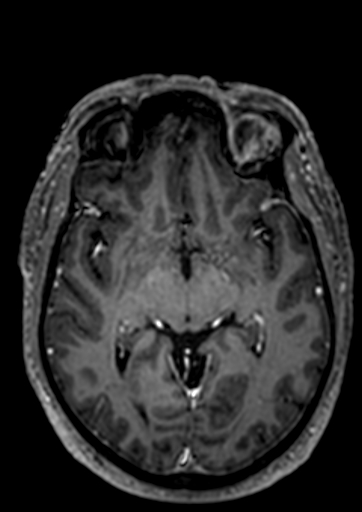 File:Accessory middle cerebral artery (Radiopaedia 73114-83828 Axial T1 C+ 55).jpg