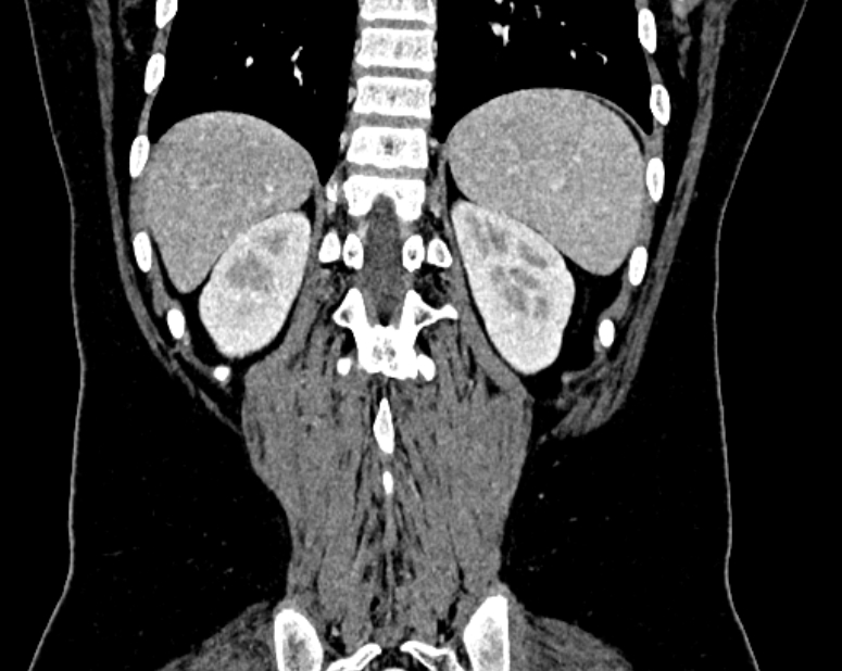 Accessory right inferior hepatic vein (Radiopaedia 75207-86305 Coronal C+ portal venous phase 65).jpg