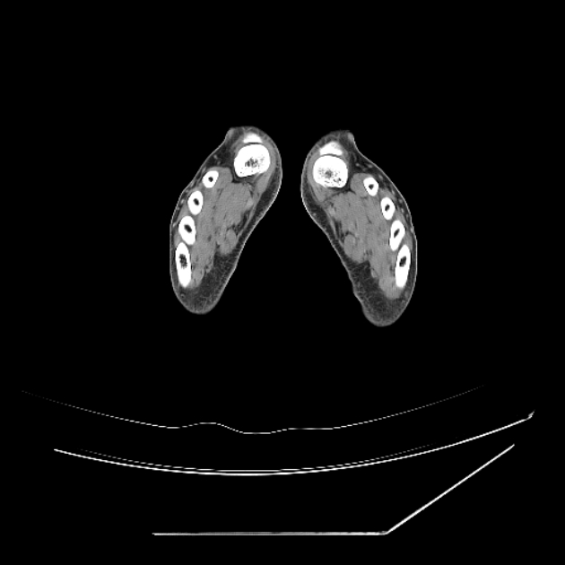 Accessory soleus muscle (Radiopaedia 61069-68943 Axial non-contrast 91).jpg