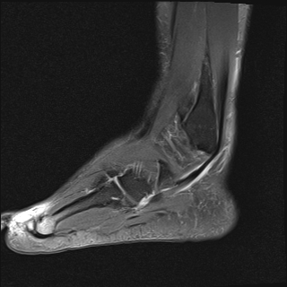 File:Achilles tendon tear (Radiopaedia 77615-89819 Sagittal PD fat sat 20).jpg