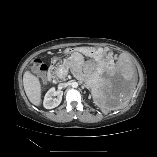 Acinar cell carcinoma of the pancreas (Radiopaedia 75442-86669 Axial C+ portal venous phase 53).jpg