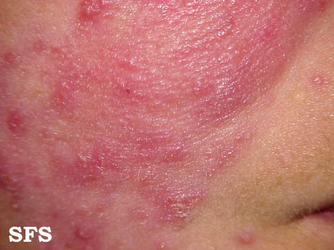 File:Acne Rosacea (Dermatology Atlas 2).jpg
