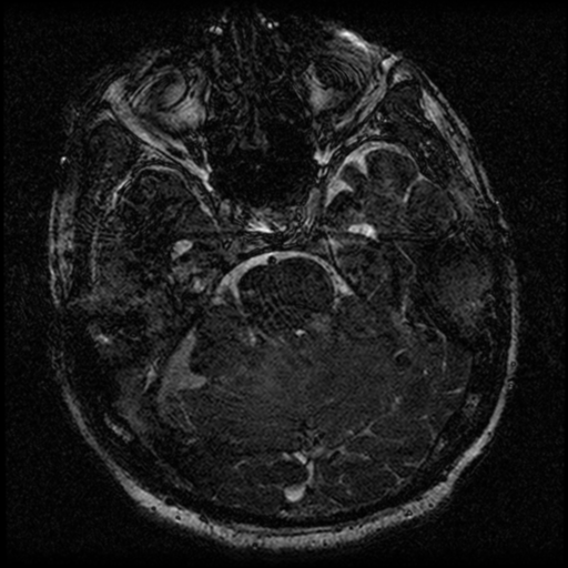 File:Acoustic schwannoma (Radiopaedia 39170-41387 Axial FIESTA 92).png