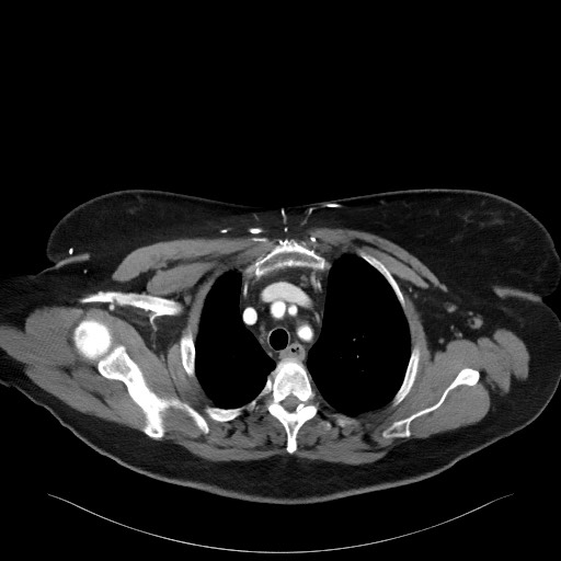 Acromioclavicular joint cyst (Radiopaedia 58455-65610 Axial C+ arterial phase 34).jpg