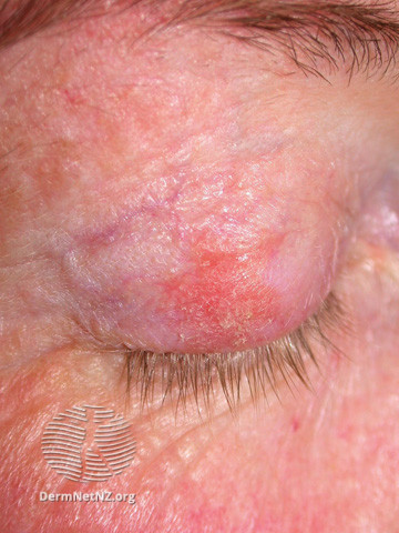 File:Actinic Keratoses treated with imiquimod (DermNet NZ lesions-ak-imiquimod-3761).jpg