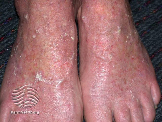File:Actinic keratoses affecting the legs and feet (DermNet NZ lesions-ak-legs-424).jpg