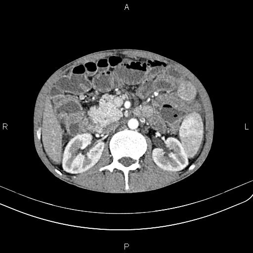 Active crohn disease (Radiopaedia 87133-103397 Axial C+ arterial phase 43).jpg
