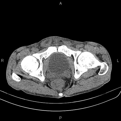 File:Active crohn disease (Radiopaedia 87133-103397 Axial non-contrast 99).jpg