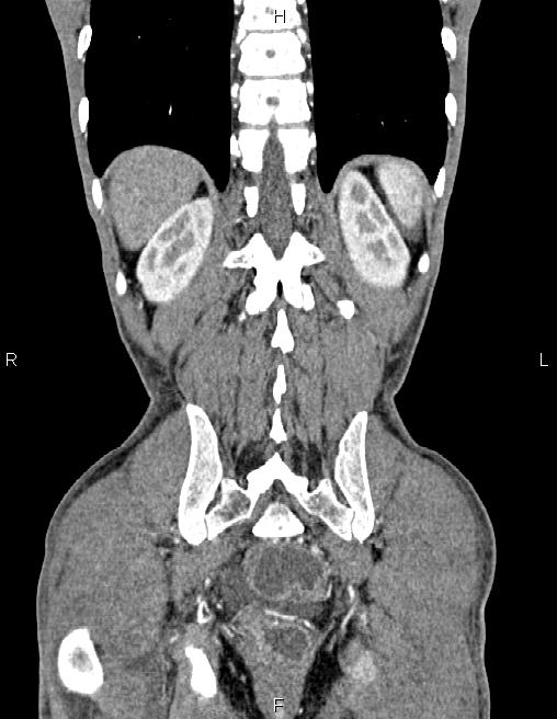 Active crohn disease (Radiopaedia 87133-103397 Coronal C+ arterial phase 54).jpg