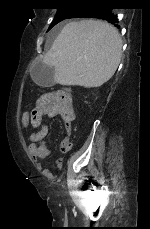 Active renal extravasation with large subcapsular and retroperitoneal hemorrhage (Radiopaedia 60975-68796 Sagittal C+ portal venous phase 166).jpg