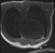 Active right ventricular cardiac sarcoidosis (Radiopaedia 55596-62100 Axial Dynamic perfusion scan MOCO 17).jpg