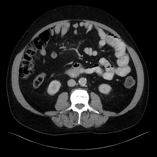 Acute-on-chronic pancreatitis (Radiopaedia 67286-76656 Axial C+ portal venous phase 41).jpg