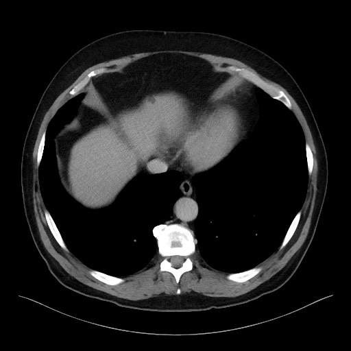 Acute-on-chronic pancreatitis (Radiopaedia 67286-76656 Axial C+ portal venous phase 9).jpg