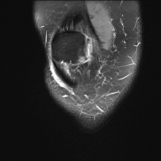 File:Acute-on-chronic transient lateral patellar dislocation with trochlear dysplasia (Radiopaedia 84099-99349 Coronal PD fat sat 34).jpg