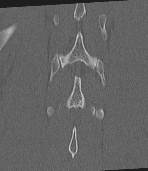 Acute L1 burst compression fracture (Radiopaedia 34430-35755 Coronal bone window 51).png