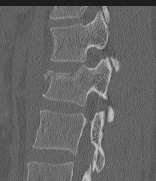 File:Acute L1 burst compression fracture (Radiopaedia 34430-35755 Sagittal bone window 42).png