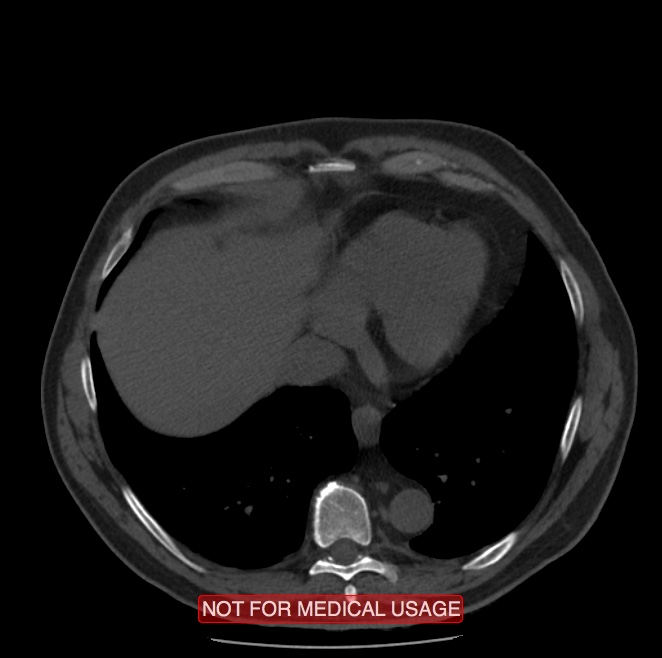 Acute aortic dissection - Stanford type A (Radiopaedia 40661-43285 Axial non-contrast 53).jpg