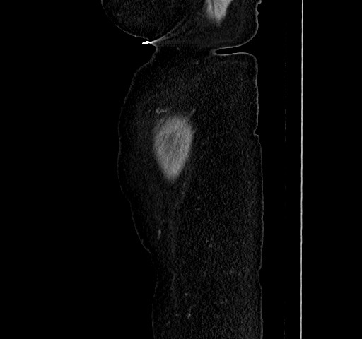 Acute appendicitis, heterotaxy syndrome (Radiopaedia 66884-76202 Sagittal C+ portal venous phase 124).jpg