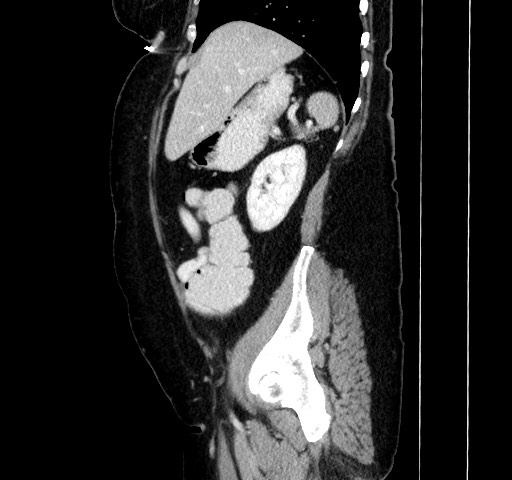 Acute appendicitis, heterotaxy syndrome (Radiopaedia 66884-76202 Sagittal C+ portal venous phase 43).jpg