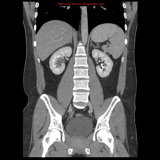 File:Acute appendicitis (Radiopaedia 10498-10973 F 29).jpg