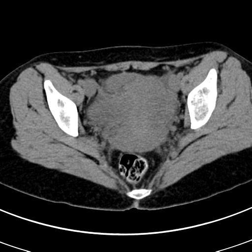 Acute appendicitis (Radiopaedia 30261-30888 Axial non-contrast 94).jpg