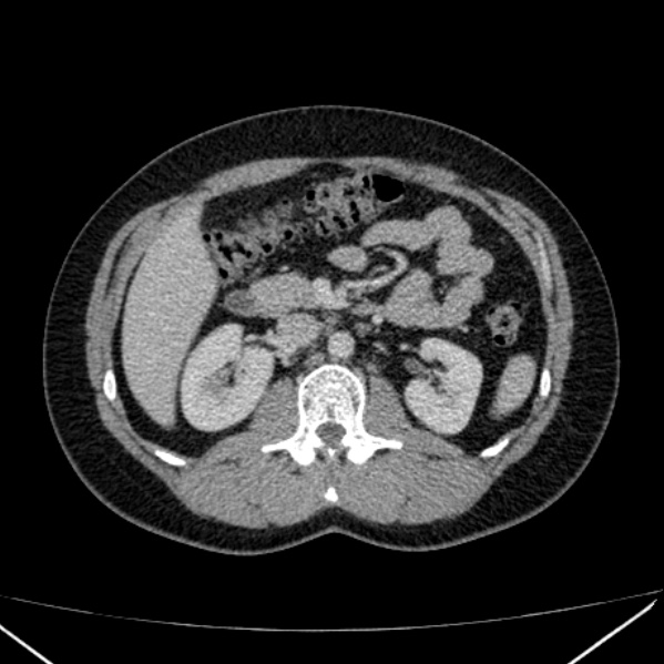 Acute appendicitis (Radiopaedia 38255-40270 Axial C+ portal venous phase 41).jpg