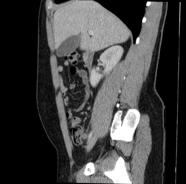 Acute appendicitis (Radiopaedia 38255-40270 Sagittal C+ portal venous phase 30).jpg
