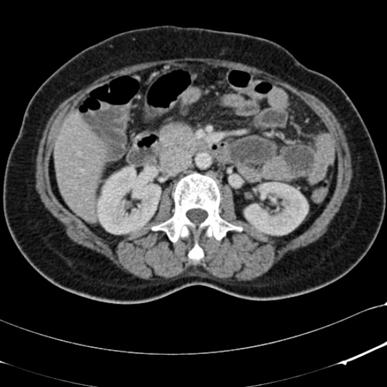 Acute appendicitis (Radiopaedia 48792-53822 Axial C+ portal venous phase 47).jpg