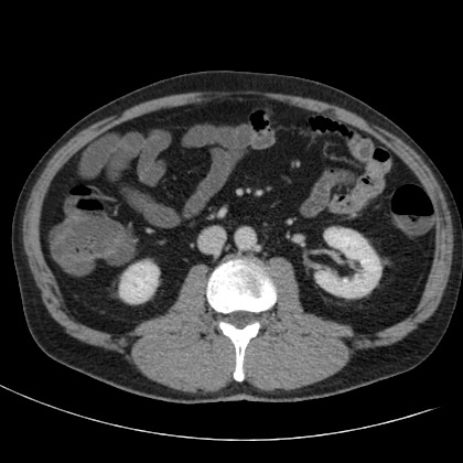 Acute appendicitis (Radiopaedia 66513-75790 Axial C+ portal venous phase 34).jpg