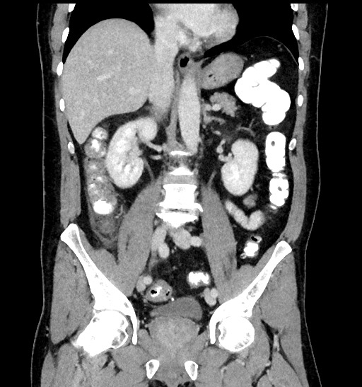 Acute appendicitis (Radiopaedia 77016-88960 Coronal C+ portal venous phase 55).jpg