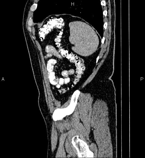 Acute appendicitis (Radiopaedia 84780-100240 Sagittal C+ portal venous phase 92).jpg