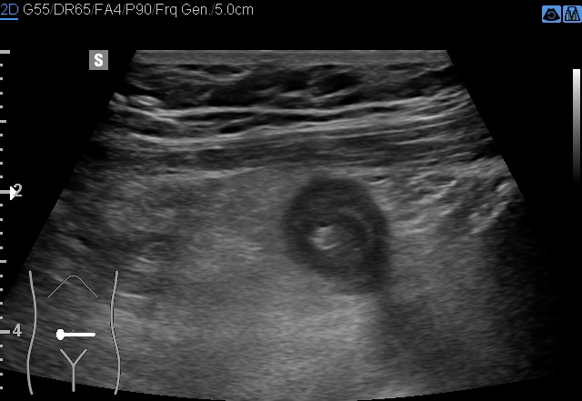 File:Acute appendicitis (Radiopaedia 85193-100745 D 165).jpg