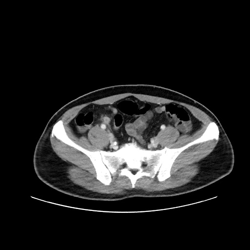 Acute appendicitis and COVID 19 pneumonia (Radiopaedia 76604-88380 Axial C+ portal venous phase 64).jpg