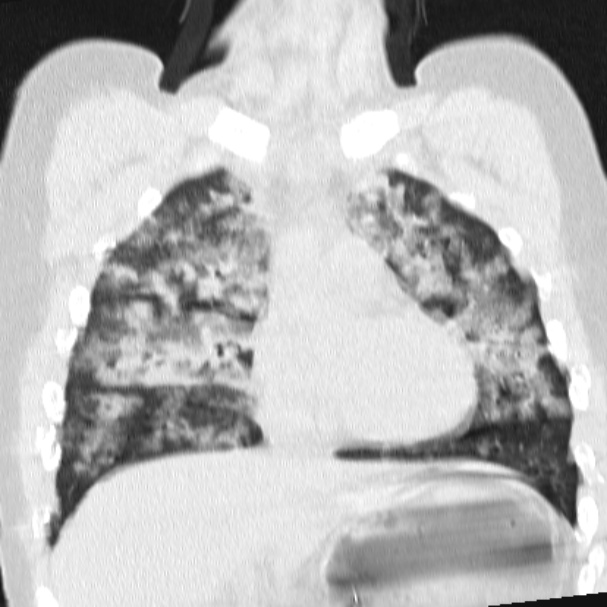 Acute aspiration pneumonitis (Radiopaedia 33605-34703 Coronal lung window 35).jpg