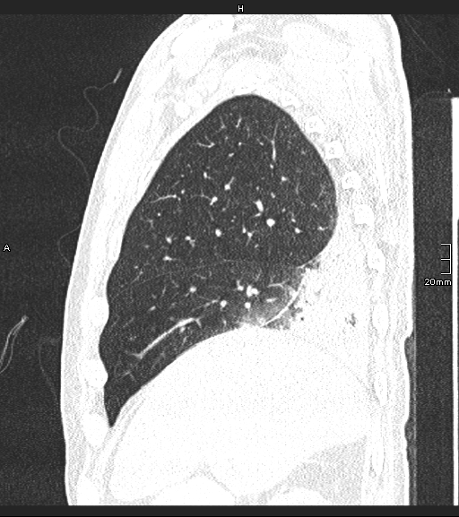 Acute aspiration pneumonitis (Radiopaedia 55642-62166 Sagittal lung window 120).jpg