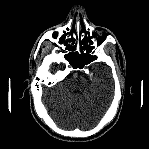 Acute basilar artery occlusion (Radiopaedia 43582-46985 Axial non-contrast 64).jpg