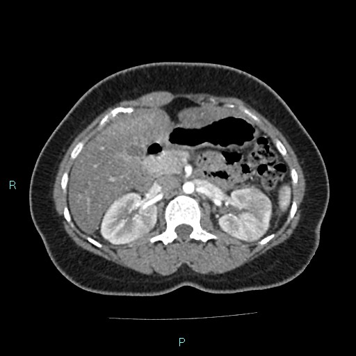 File:Acute bilateral pyelonephritis (Radiopaedia 37146-38881 Axial C+ arterial phase 69).jpg
