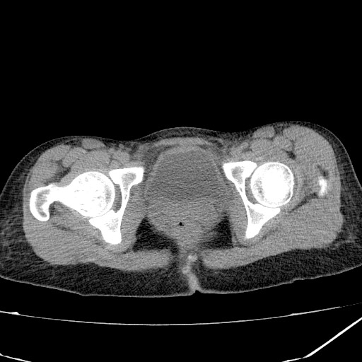Acute bilateral pyelonephritis (Radiopaedia 74153-84969 Axial non-contrast 49).jpg