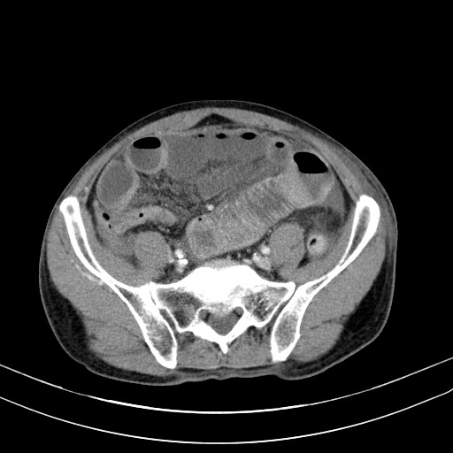 Acute bowel ischemia (Radiopaedia 87695-104114 Axial C+ portal venous phase 63).jpg