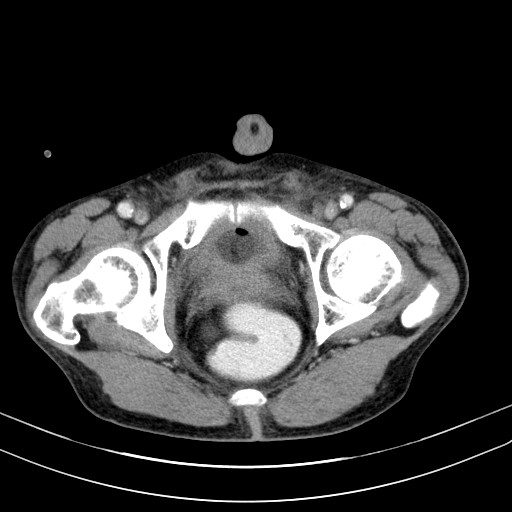 Acute bowel ischemia (Radiopaedia 87695-104114 Axial C+ portal venous phase 83).jpg