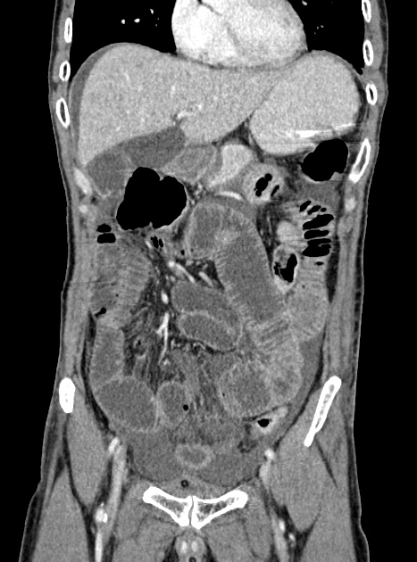 Acute bowel ischemia (Radiopaedia 87695-104114 Coronal C+ portal venous phase 155).jpg