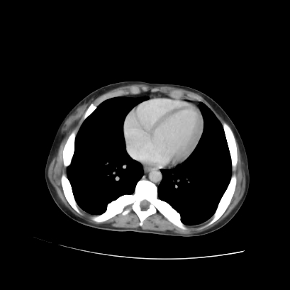 Acute calculous cholecystitis in patient with osteopetrosis (Radiopaedia 77871-90159 Axial C+ portal venous phase 11).jpg