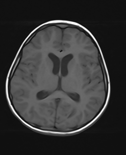 File:Acute cerebellar ataxia (Radiopaedia 61487-69446 Axial T1 13).jpg