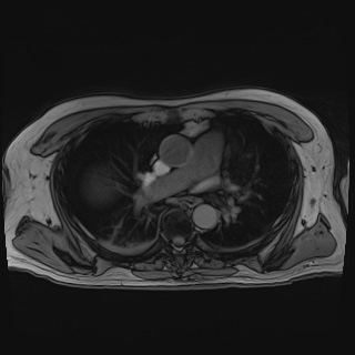 Acute cholecystitis (Radiopaedia 72392-82923 Axial T1 out-of-phase 3).jpg