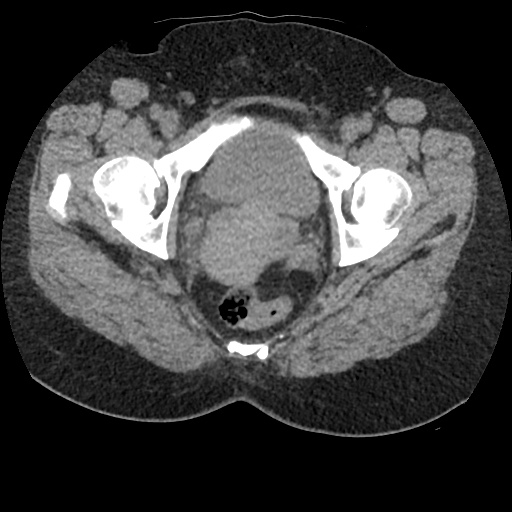Acute cholecystitis and ureteric colic (Radiopaedia 42330-45444 Axial prone 104).jpg