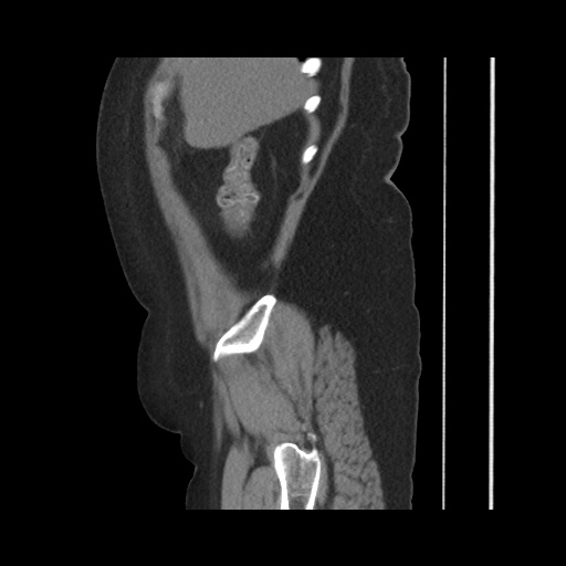 Acute cholecystitis with tensile fundus sign (Radiopaedia 71394-81723 Sagittal non-contrast 43).jpg