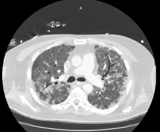 File:Acute cor pulmonale (ultrasound) (Radiopaedia 83508-98818 Axial 19).jpg